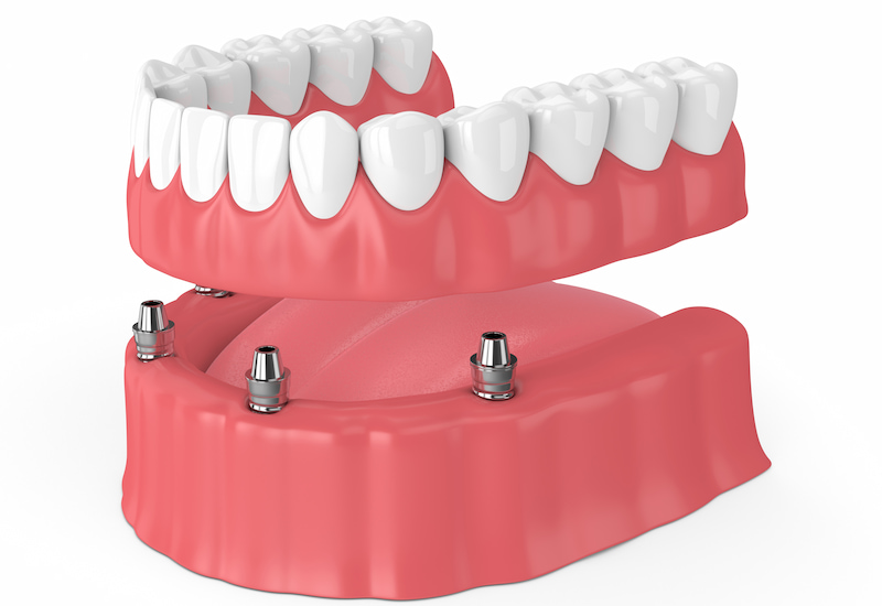 rendering of removable dentures